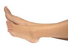 Sindromul picioarelor nelinistite (sindromul Ekbom)
