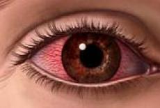 artrita reumatoidă și vederea ochilor
