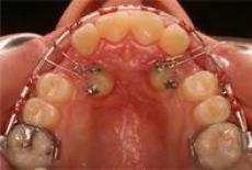 Descoperirea chirurgico-ortodontica a caninilor inclusi