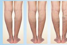 Vene și simptome interne, Varicele la picioare: ce sunt, de ce apar și cum le tratăm