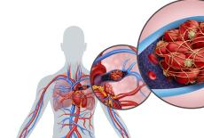Trombembolismul pulmonar - factori de risc si masuri de prevenire