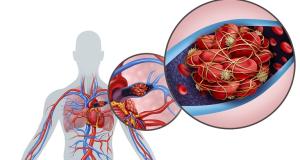 Trombembolismul pulmonar - factori de risc si masuri de prevenire