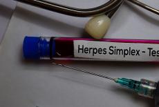 Infectia cu herpes simplex: cauze, simptome, tratament