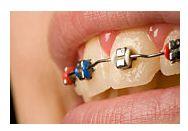 Ortodontia - indreptarea si corectarea pozitiei dintilor