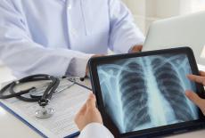 Screeningul pulmonar - instrument de diagnostic precoce al cancerului 