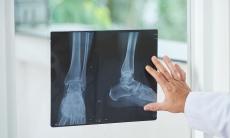 Sindromul Müller-Weiss, o boala degenerativa rara a piciorului