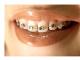Tratamentul ortodontic: tehnica linguala