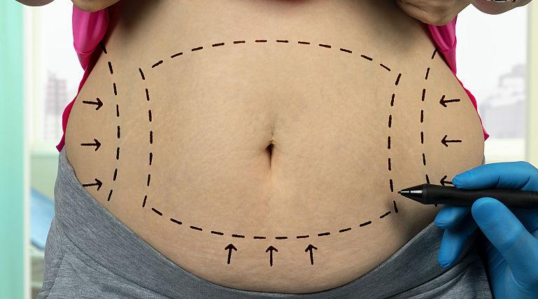 Abdominoplastia, solutia rapida pentru un abdomen atractiv