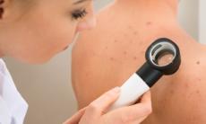 Metode eficiente care elimina cicatricile cauzate de acnee 