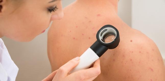 Semnele si cicatricile post acnee - putem scapa de ele? | Hebra Dermatologie