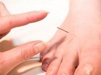 Acupunctura - o optiune terapeutica