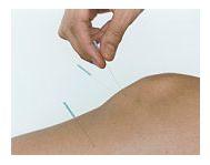Tratament de acupunctură a prostatitei