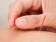 Ce nu stiai despre acupunctura: cum tratezi o boala cu un varf de ac