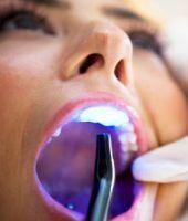 Mituri despre albirea dentara