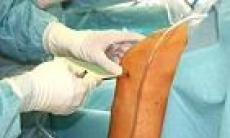 O noua tehnica de inlocuire a articulatiilor genunchiului permite deplasarea dupa 2 ore de la operatie