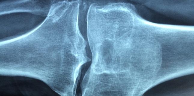 Semnele artritei inflamatorii - cum o poti trata?