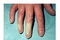 Albirea la rece a degetelor Boala Raynaud și sindromul Raynaud