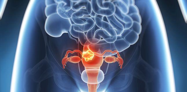 Cancerul de col uterin - simptome, cauze, tratament