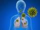 Cancerul pulmonar cu celule mici (microcelular)
