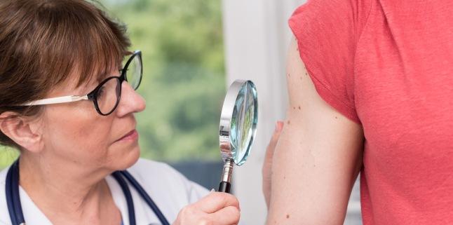 Poti fi expus riscului de a dezvolta cancer de piele?