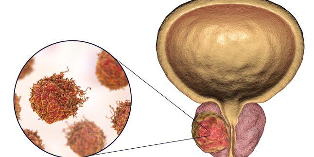 tratament naturist scadere psa cancer de prostata refractario a tratamiento hormonal