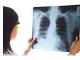 5 cauze ale aparitiei cancerului pulmonar la nefumatori