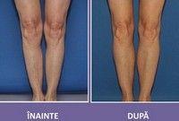 Implantul in gambe, noul trend in materie de chirurgie estetica