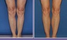 Implantul in gambe, noul trend in materie de chirurgie estetica