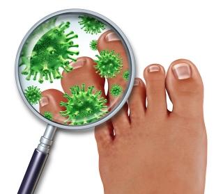 Ciuperca piciorului: 5 reguli pentru a evita infectia