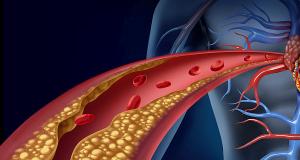 Dislipidemia - un real pericol pentru cardiaci