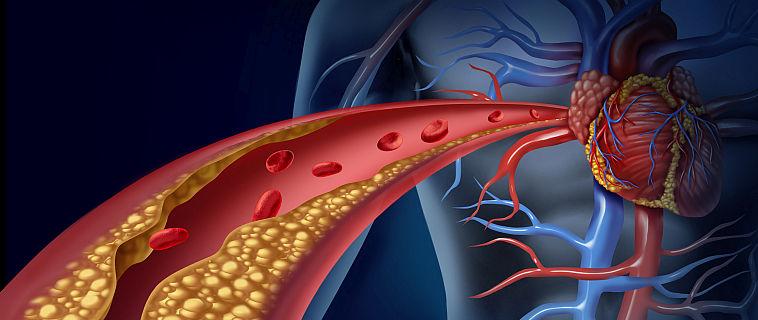 Dislipidemia - un real pericol pentru cardiaci