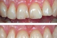 Fatetele dentare – PRO sau CONTRA