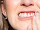 Gingivita - afectiunea gingiilor care poate duce la pierderea dintilor