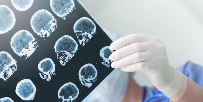 Hipoxia cerebrala sau privarea de oxigen a creierului
