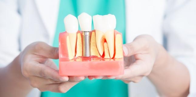 Implanturile dentare - tipuri, avantaje si riscuri
