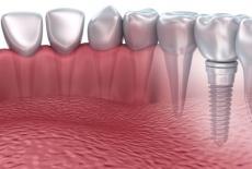  Implanturile Dentare din Zirconiu vs Implanturile din Titan