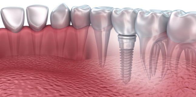  Implanturile Dentare din Zirconiu vs Implanturile din Titan
