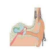 Implantul cohlear - electrozi la nivelul urechii interne