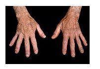 Diferența dintre lupus și artrita reumatoidă