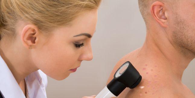 Cancerul de piele: melanomul malign