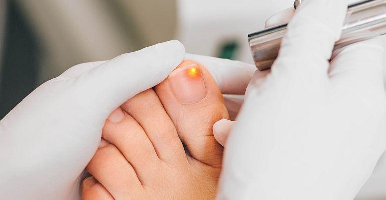 cum să îndepărtezi chirurgical ciuperca unghiilor de la picioare