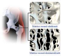 Tratamentul oaselor fragile la ora actuala. Osteoporoza