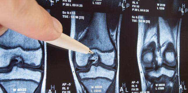 Osteoporoza – cauze, simptome, tratament și îngrijirea pacienților