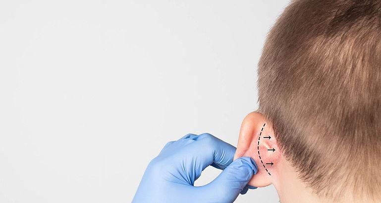 Urechile decolate(clapauge) – cand se recomanda otoplastia