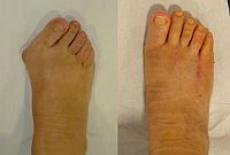 poliartrita reumatoida picior