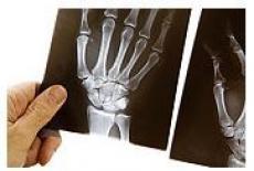 Osteoporoza - Ce este? Cauzele aparitiei, Simptome si Tratament | CENTROKINETIC