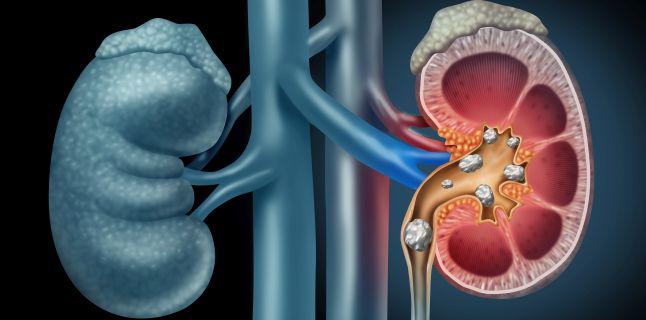 Unde dor rinichii: Cum deosebești de durerile lombare – cauze și tratamente