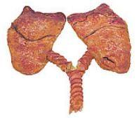 Abcesul pulmonar 