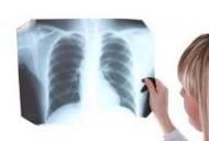 Cancerul Pulmonar Cu Celule Mici Microcelular