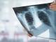 Tuberculoza (TBC): simptome si tratament 